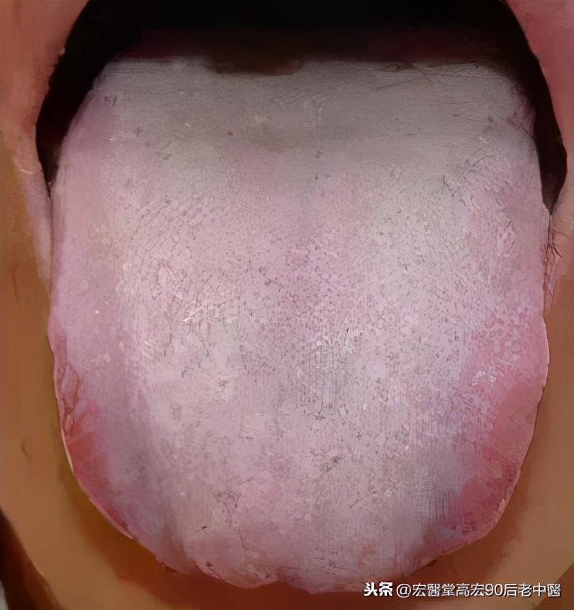 舌苔变色查出卵巢癌警惕舌苔变色，可能是卵巢癌的信号